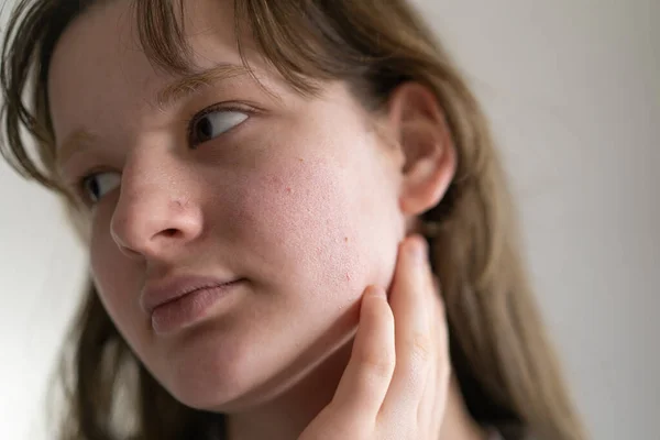 问题皮肤脸 一个面目全非的少女青少年畸形皮肤 关心问题的皮肤 痤疮治疗 — 图库照片