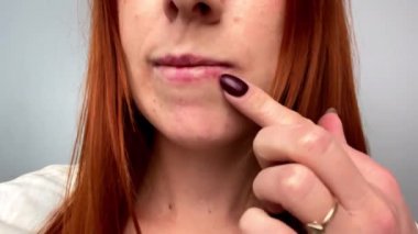 Dudaklarındaki uçuk yaralarına dokunan kadın. Kadın yüzünde tahriş belirtileri. Herpes simpleksinin yol açtığı viral hastalığın sivilceleri.