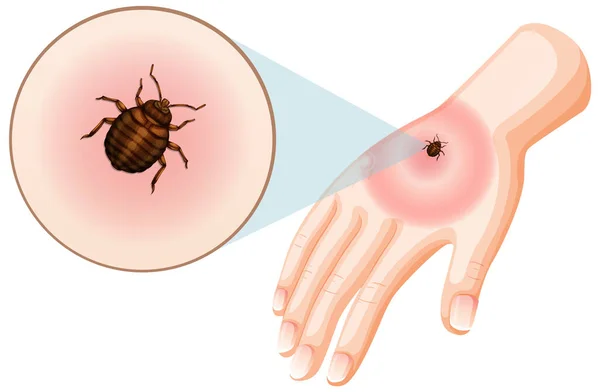 Bed Bug Bites Sting Skin Illustration — Stock Vector