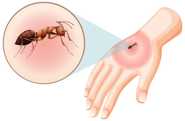 Mierenbeten Steken Huid Illustratie — Stockvector