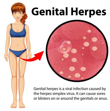 Genital Herpes infographic with explanation illustration