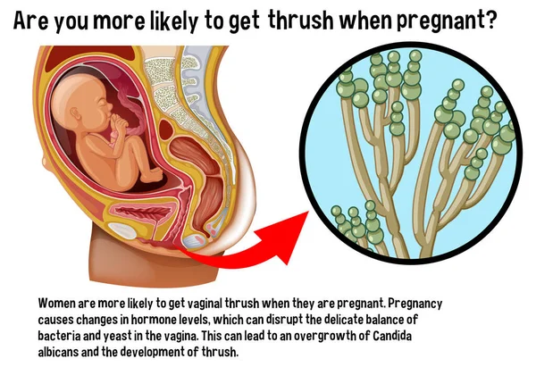 Vaginal Thrush Pregnancy Infographic Explanation Illustration — Stock Vector