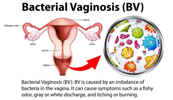 Bacteriële Vaginose Infographic Met Uitleg Illustratie — Stockvector
