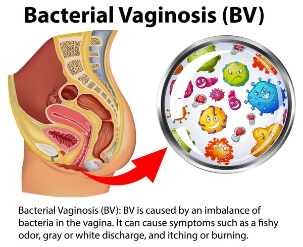 Bacteriële Vaginosis Infographic Met Uitleg Illustratie — Stockvector