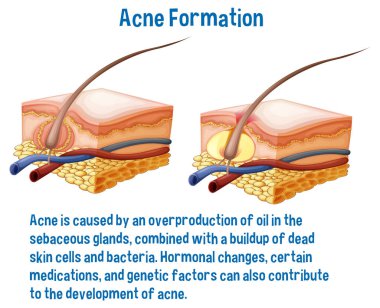 Acne formation information explanation illustration