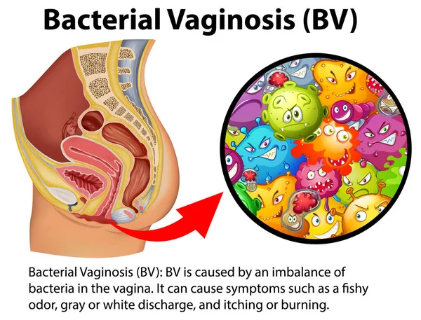 Infografía Vaginosis Bacteriana Con Ilustración Explicativa — Vector de stock