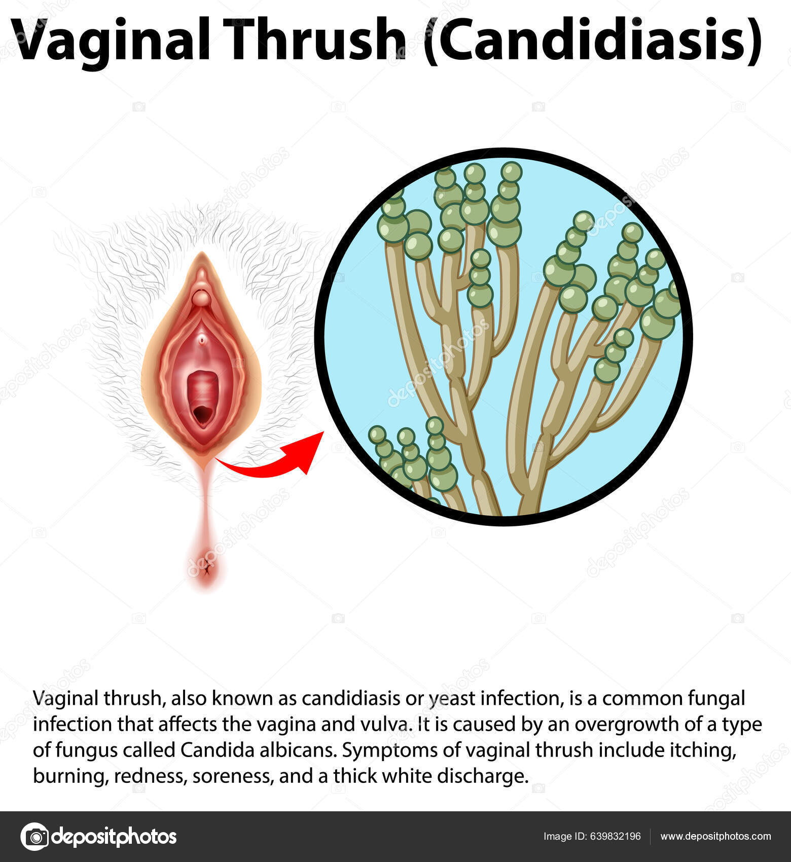 Descargar Vaginal Thrush Candidiasis Infographic With Explanation Illustration — Ilustración 9068