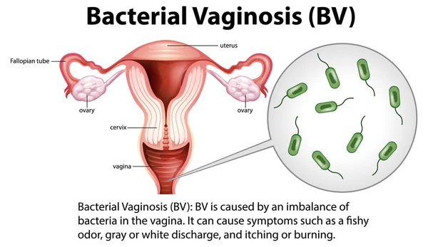 Infografía Vaginosis Bacteriana Con Ilustración Explicativa — Vector de stock