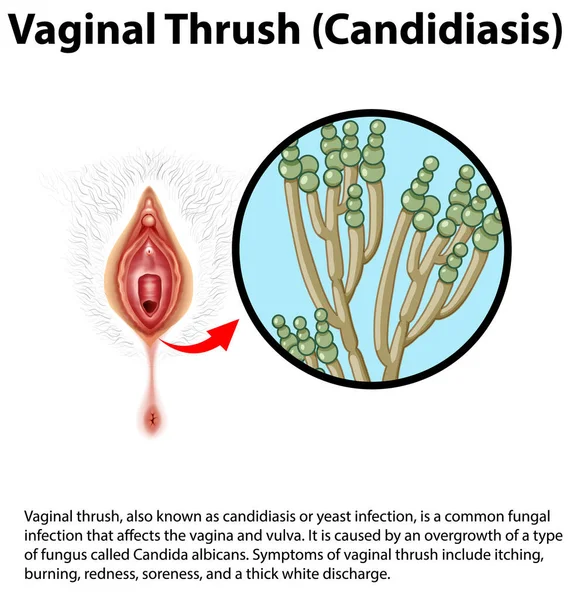 Vaginal Thrush Candidiasis Infographic Explanation Illustration — Stock Vector