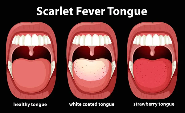 Scarlet Fever Tongue Symptoms Illustration —  Vetores de Stock