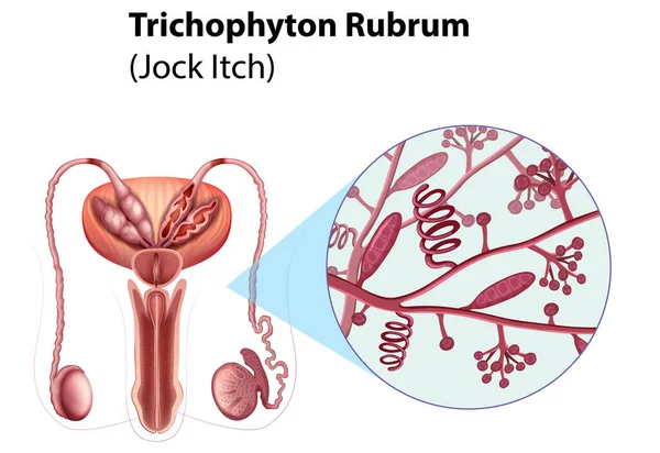 Trichophyton Rubrum Fungal Infection Illustration — Stock Vector