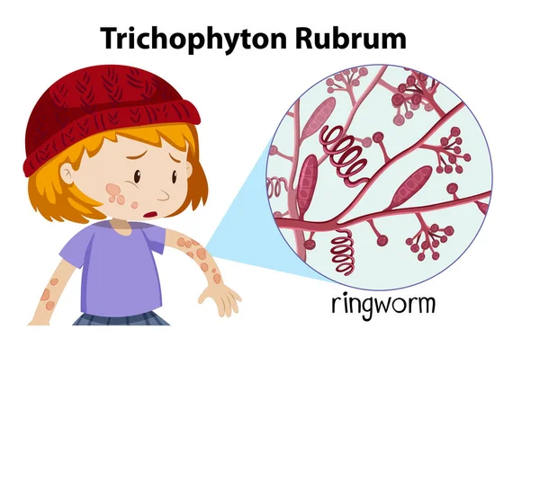 Иллюстрация Грибковой Инфекции Трихофитона Рубрума — стоковый вектор
