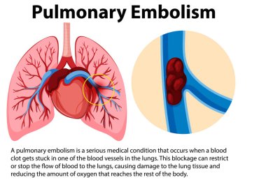 Pulmonary embolism with explanation illustration