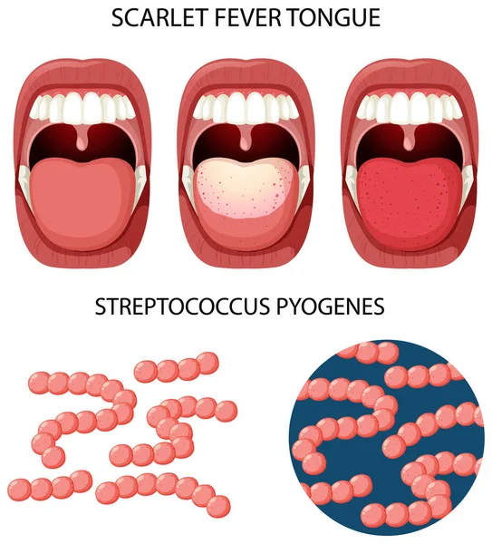 Scarlet Fever Tongue Symptoms Illustration — Vector de stock