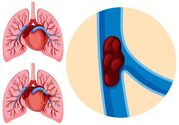 Human Anatomy Pulmonary Embolism Illustration — Vettoriale Stock