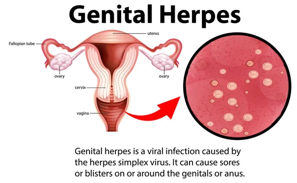 Genital Herpes Infographic Explanation Illustration — Vector de stoc