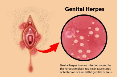Genital Herpes infographic with explanation illustration