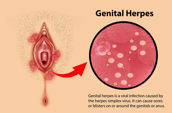 Genital Herpes Infographic Explanation Illustration — Stock Vector