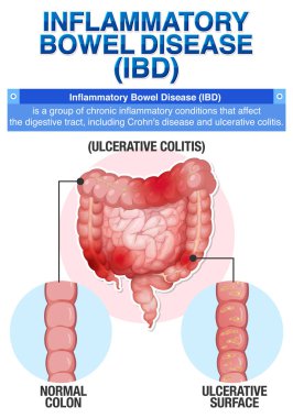 İltihaplı Bağırsak Hastalığı (IBD) Infographic Illustration