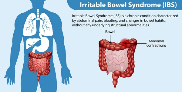 Irritable Bowel Syndrome Ibs Infographic Illustration — Stock Vector