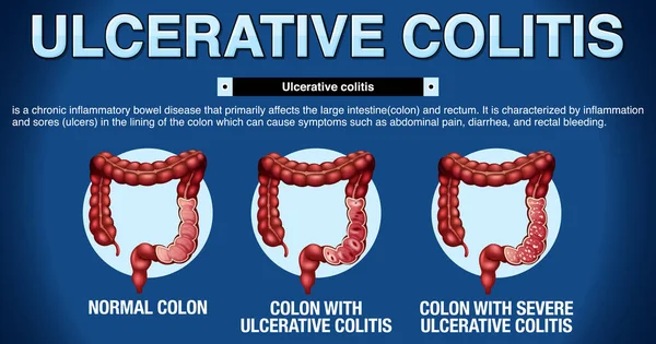 Colitis Ulcerosa Síntomas Infografía Ilustración — Archivo Imágenes Vectoriales