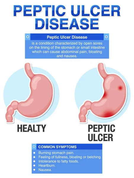 Choroba Wrzodowa Żołądka Wyjaśniona Ilustracja Infograficzna — Wektor stockowy