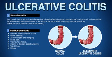 Ülseratif Kolit Belirtileri Bilgisel İllüstrasyon