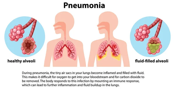 Pneumonie Pulmonaire Avec Explication Illustration — Image vectorielle