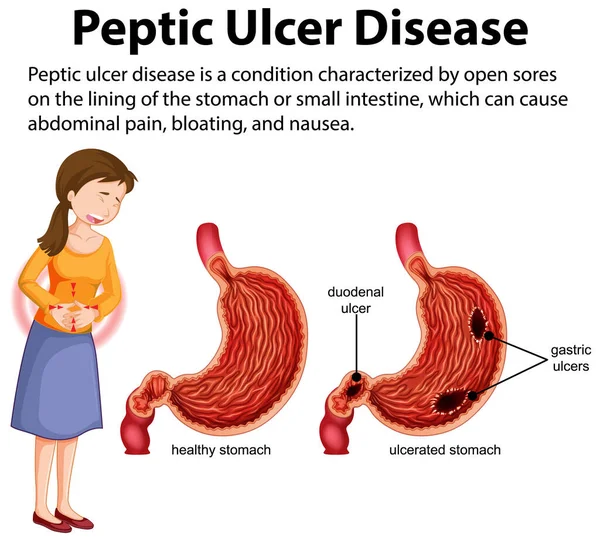 Інфографічна Ілюстрація Peptic Ulcer Disease — стоковий вектор