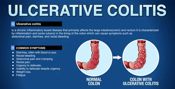 Stock vector Ulcerative Colitis Symptoms Infographic illustration