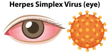 Herpes simplex virüsü (Göz) illüstrasyonu