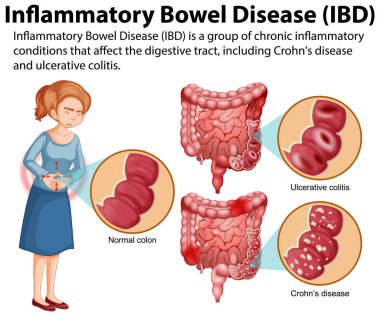 İltihaplı Bağırsak Hastalığı (IBD) Infographic Illustration
