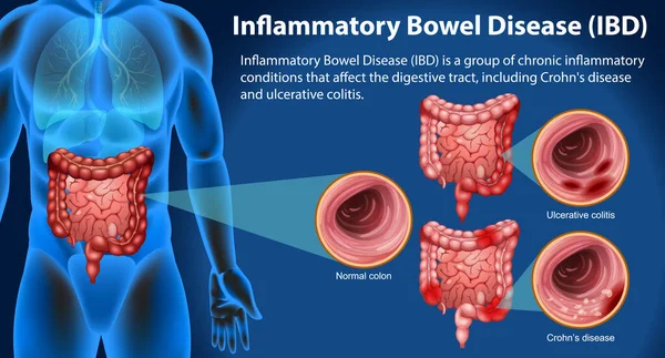 Maladie Inflammatoire Intestin Mii Illustration Infographique — Image vectorielle