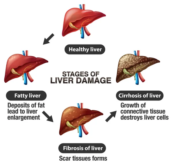 肝脏损害的各个阶段信息图解 — 图库矢量图片