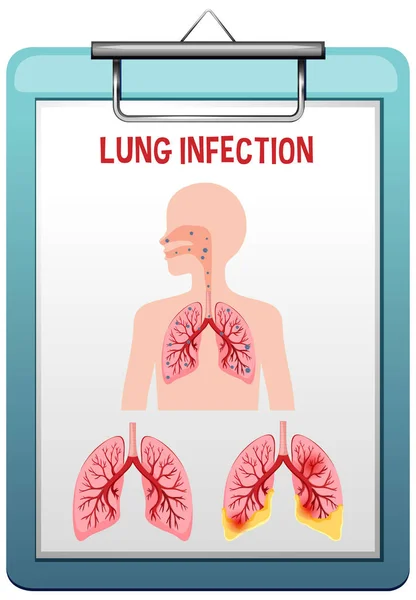 Illustration Vectorielle Pneumonie Infection Pulmonaire — Image vectorielle
