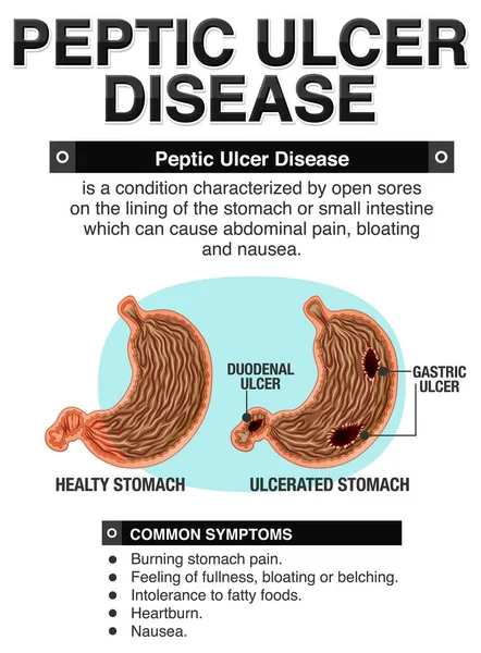 stock vector Peptic Ulcer Disease Infographic illustration