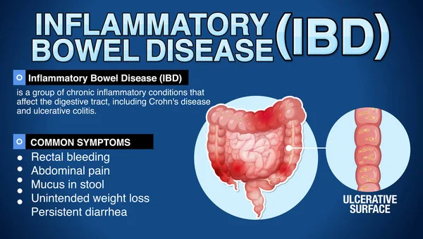 stock vector Inflammatory Bowel Disease (IBD) Infographic illustration