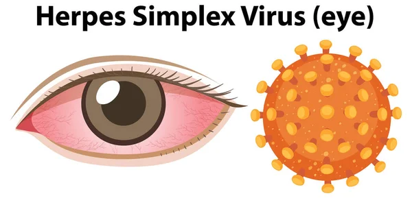 Ilustração Vírus Herpes Simplex Olho — Vetor de Stock