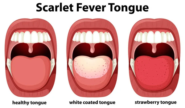 Scarlet Fever Tongue Symptoms Illustration — Stockový vektor