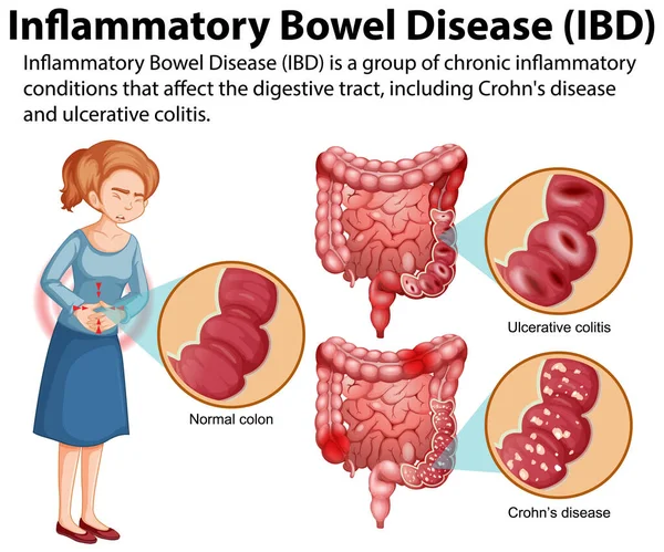 Inflammatorisk Tarmsjukdom Ibd Infographic Illustration — Stock vektor