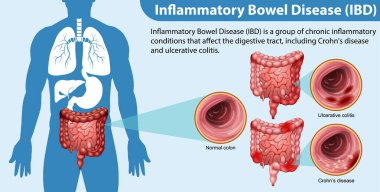 İltihaplı Bağırsak Hastalığı (IBD) Infographic Illustration