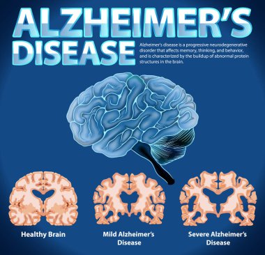 Alzheimer Hastalığı illüstrasyonunun bilgilendirici posteri
