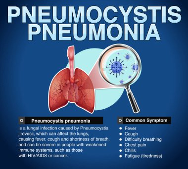 Pneumocystis pnömoni illüstrasyonunun bilgilendirici posteri