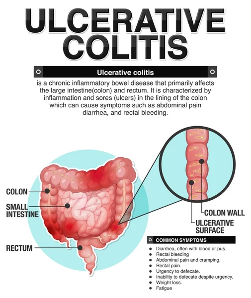 Ulcerös Kolit Symtom Infografisk Illustration — Stock vektor