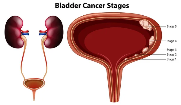 膀胱癌分期病媒图解 — 图库矢量图片