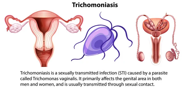 Trichomoniasis Infographic Explanation Illustration - Stok Vektor
