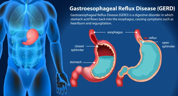 Reflux Gastro Œsophagien Illustration Diagramme — Image vectorielle