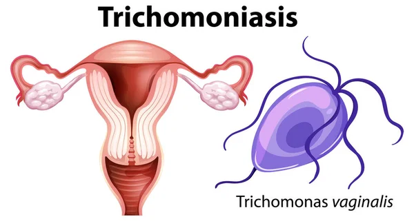 Trichomonas Vaginalis Bílém Pozadí Ilustrace — Stockový vektor