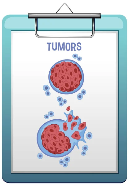 Tumor Cell Cancer Development Illustration — Stock Vector