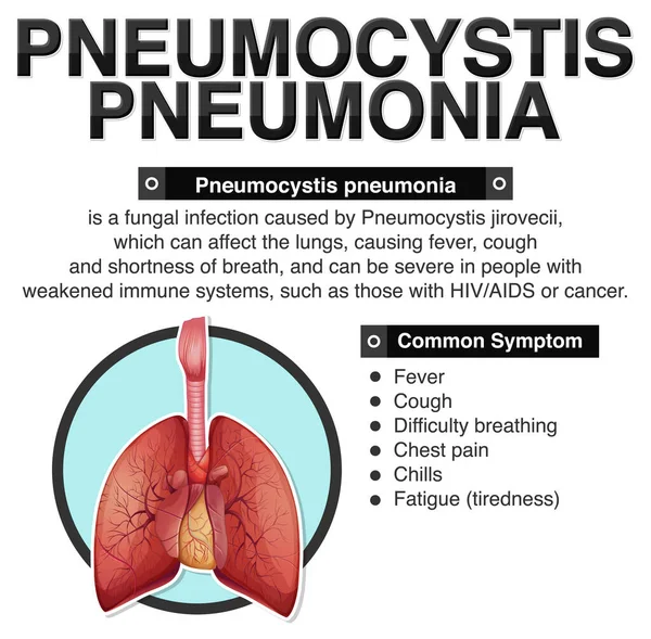 Informative Poster Pneumocystis Pneumonia Illustration — Stock Vector
